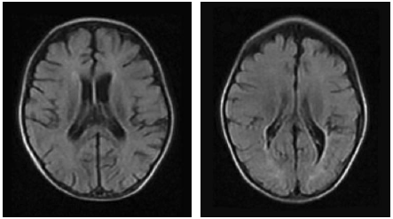 Das linke Bild zeigt das Gehirn eines unterernährten, zehn Monate alten Kindes. Das Gehirn (weiss) zieht sich vom Schädelknochen und den Blutgefässen zurück. Rechts sieht man das Gehirn des gleichen Kindes nach 90 Tagen Behandlung. (Quelle: El-Sherif et al. 2012)
